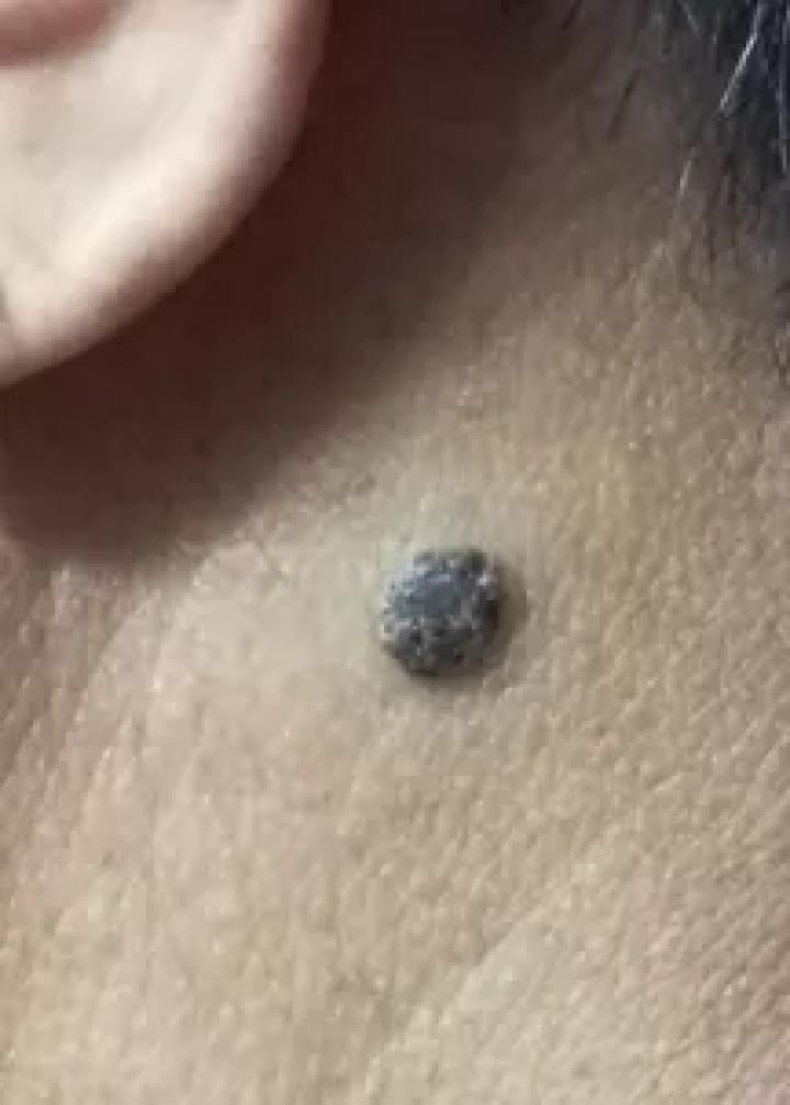 哪些部位长痣预示一生劳碌,痣的位置预示着什么