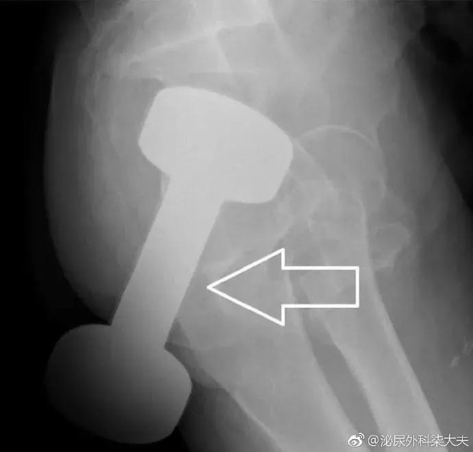 罗非鱼塞进直肠多长时间,星医百可以长期吃吗