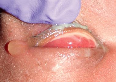 宝宝红眼病好的征兆,新生宝宝眼睛有点黄是怎么回事