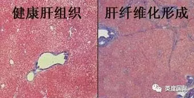 肝纤维化怎样有效逆转,肝纤维化怎么治疗有效果啊