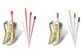 i型根管如何预备和充填,根管预备后可以直接充填吗