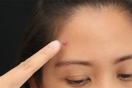 痘痘肌有效治理帮你轻松终结战痘,一招搞定顽固痘痘