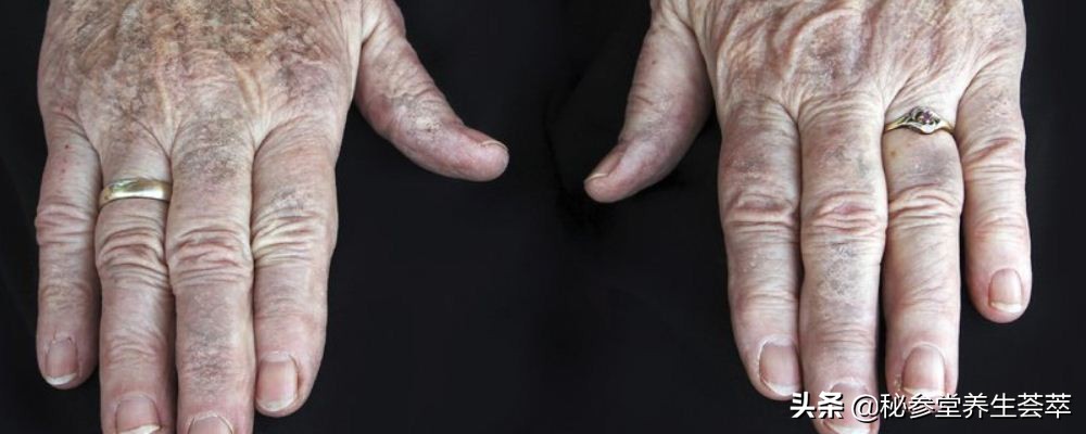 手上长老年斑怎么预防小妙招,手上长老年斑是什么问题