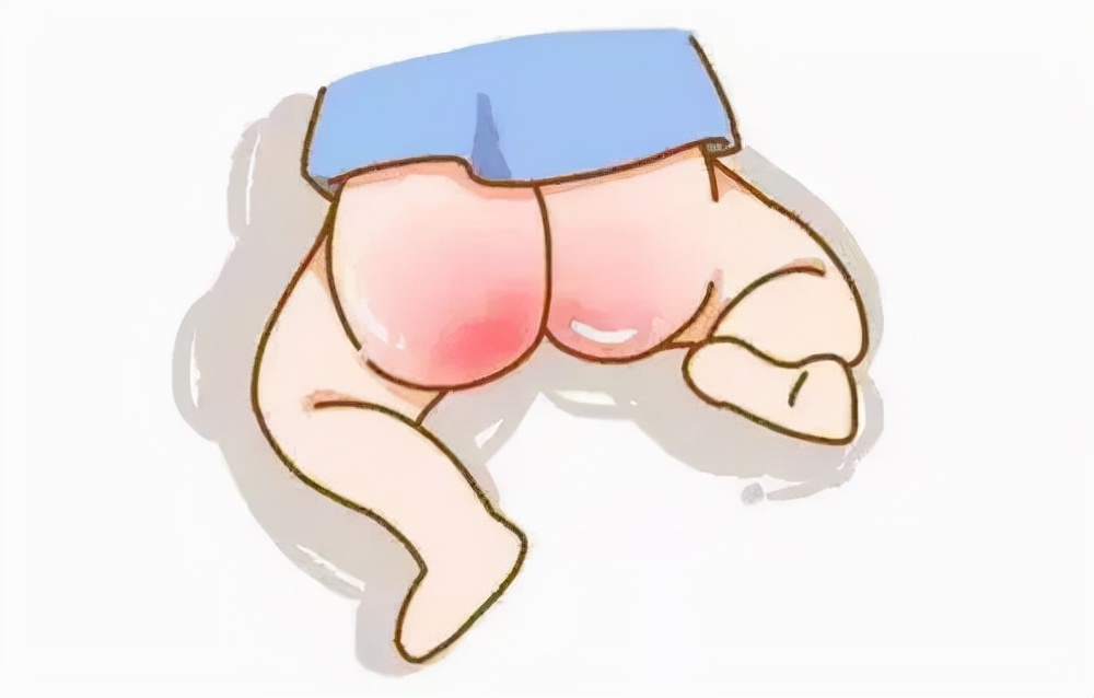 新生儿红臀,新生儿红臀的处理的方法