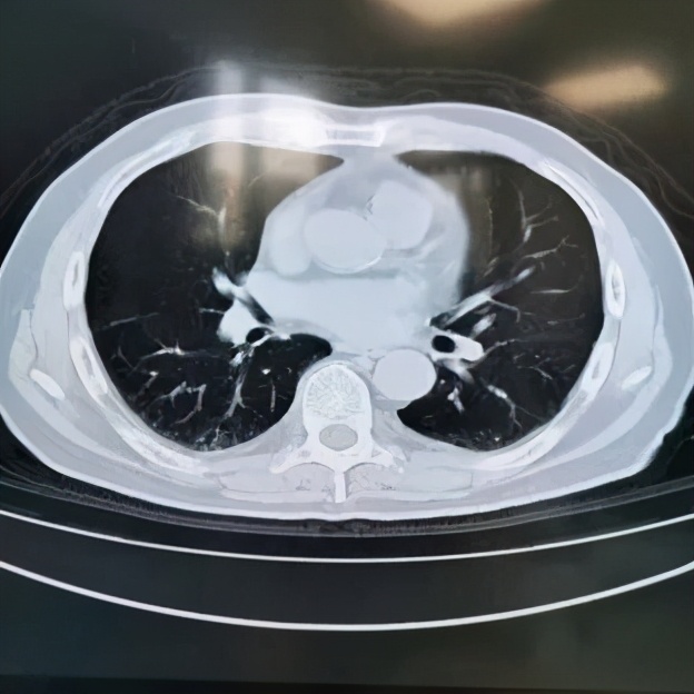 阵发性房颤和用药有关系吗,房颤药物控制好了还会复发吗