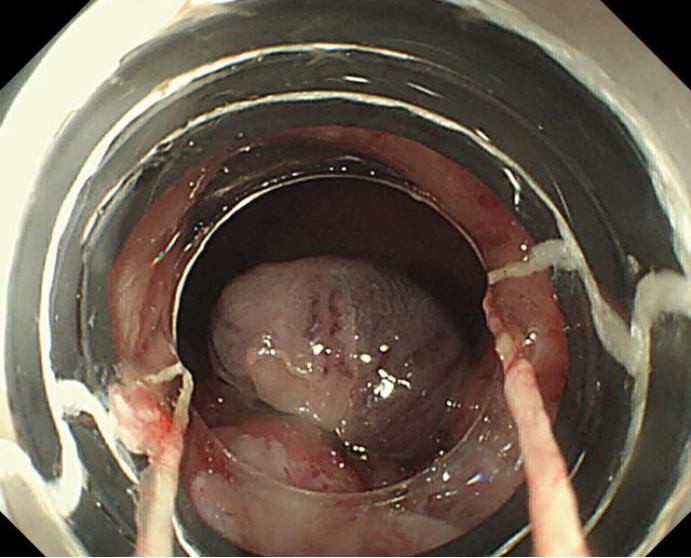 做肠镜喝泻药痔疮出来了怎么办,肠镜检查发现有痔疮可以切掉吗