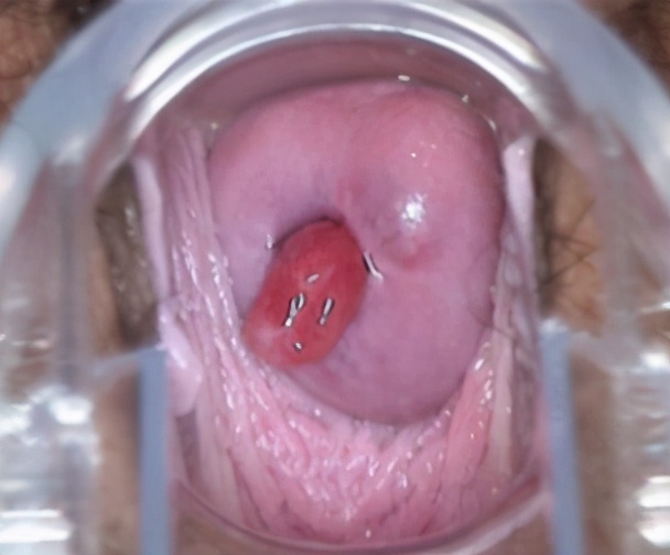 宫颈炎到底要不要治疗？