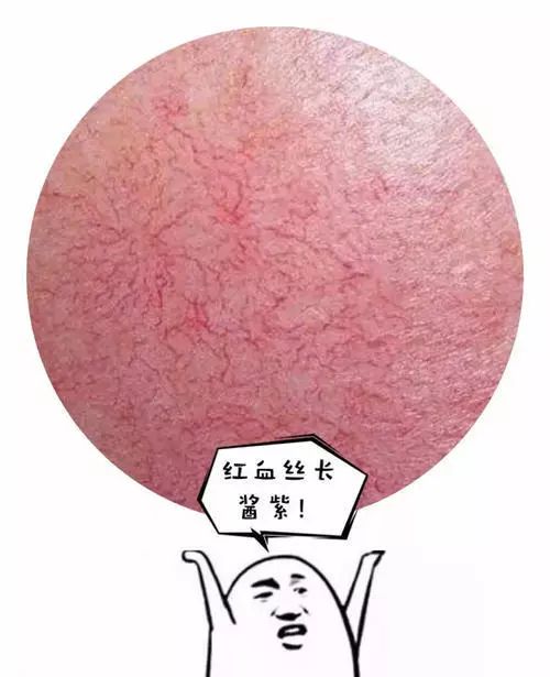 脸上红血丝不用护肤品怎么解决,脸上有红血丝用什么腮红