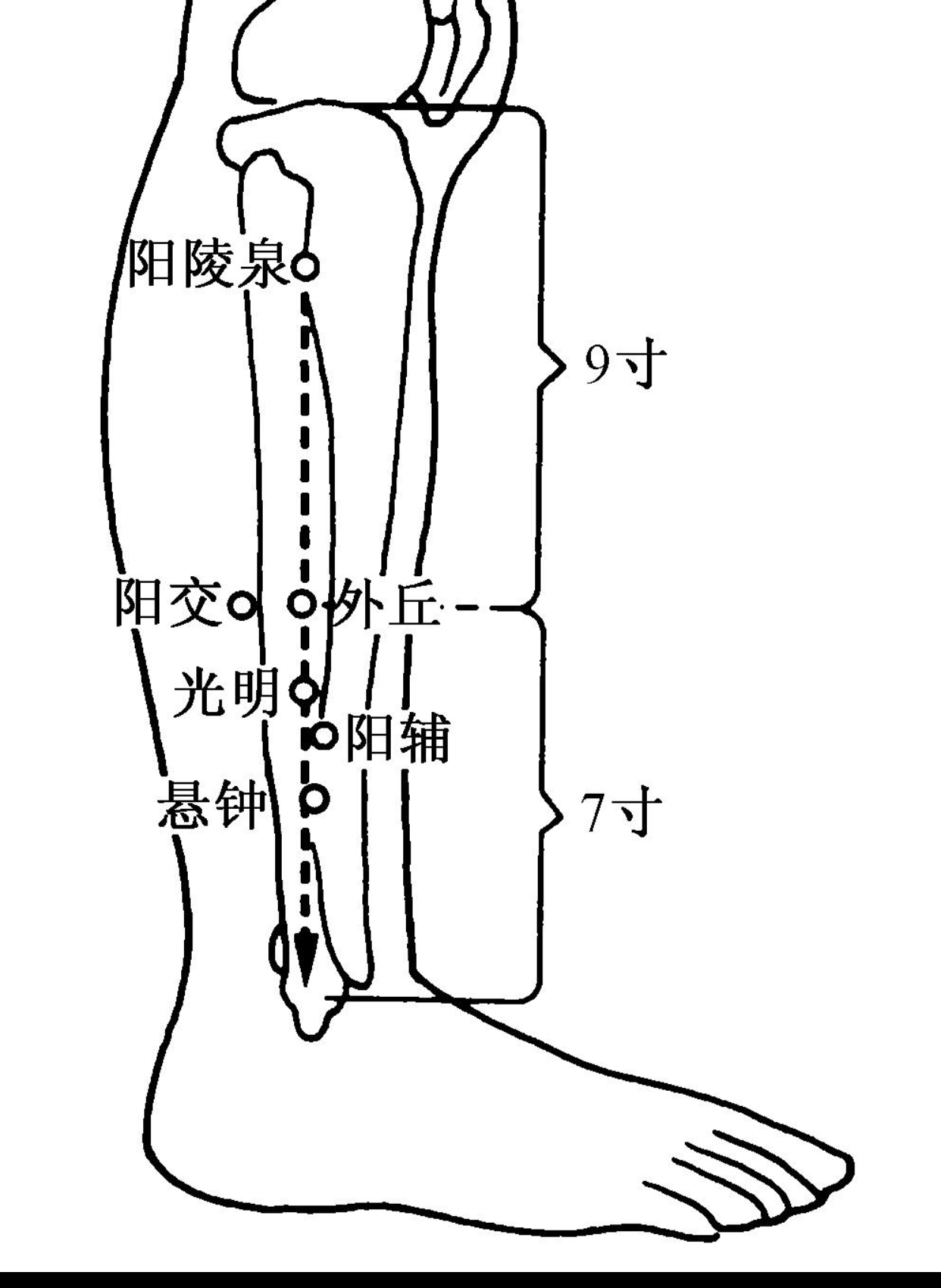 一针疗法高树中落枕,落枕针灸内关穴一针见效