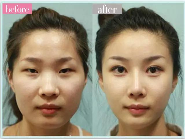 不建议做双眼皮的三种情况,为什么不建议做双眼皮