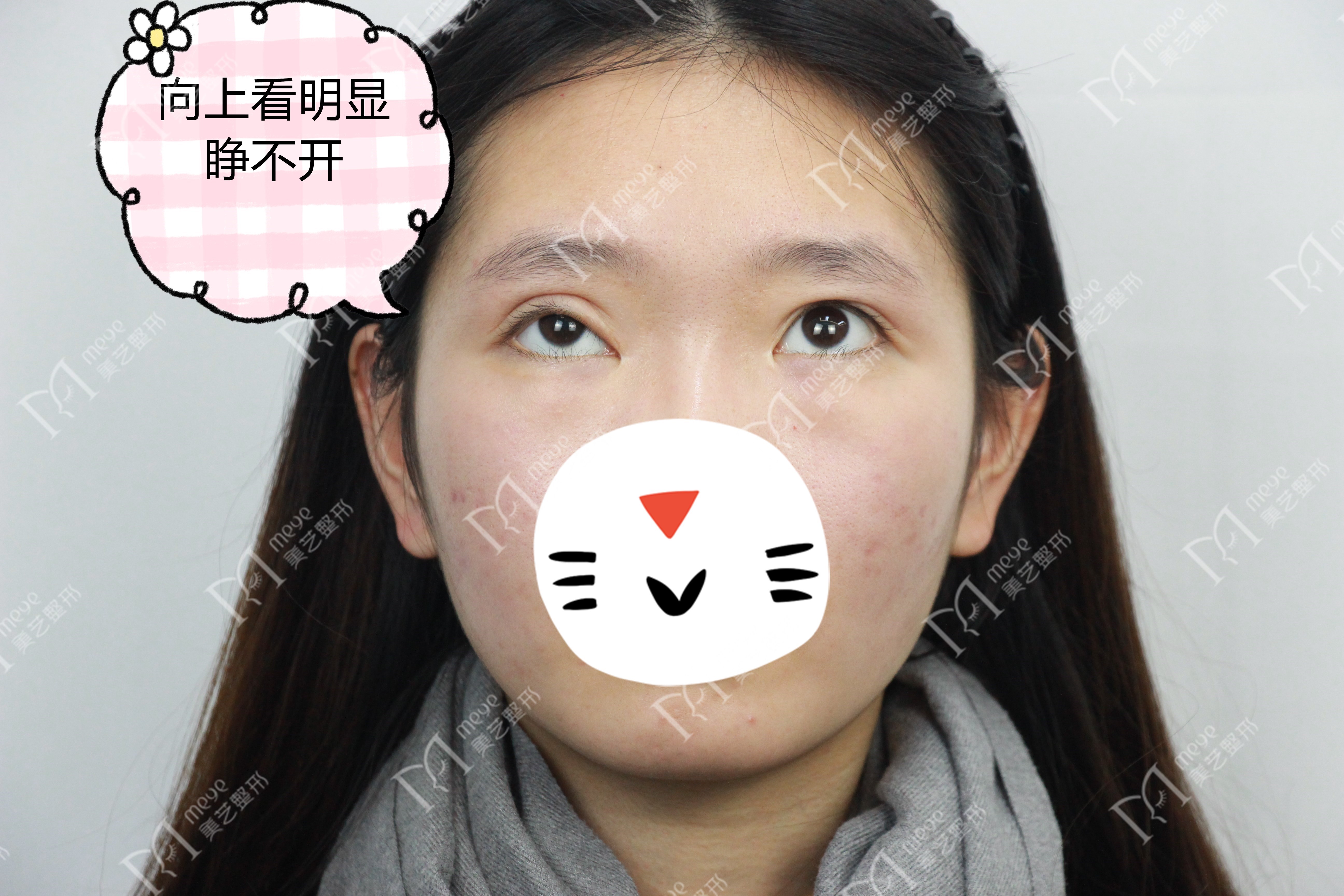 单眼上睑下垂修复术,上睑下垂眼睛修复手术成功率高吗