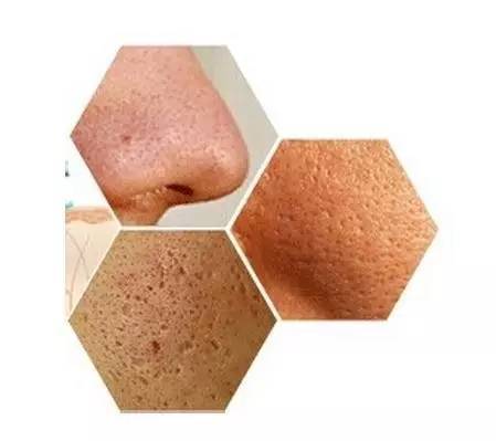 如何拯救肉眼可见的毛孔粗大,改善毛孔粗大的方法和注意事项