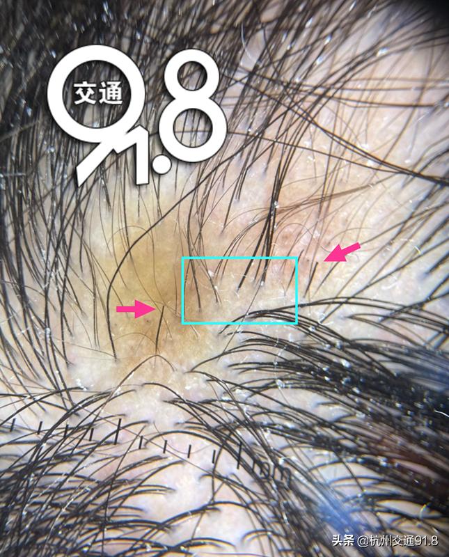 11岁女孩有斑秃,11岁女孩突然掉发斑秃