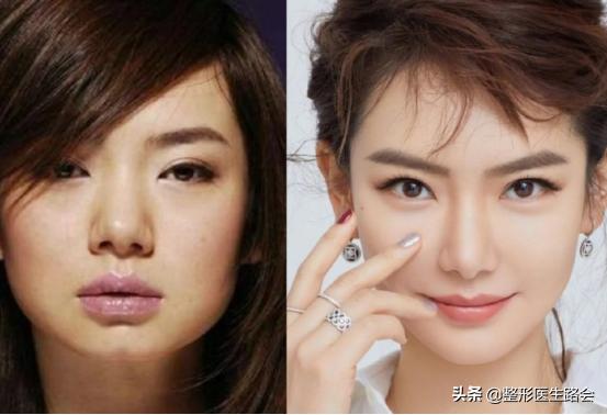 想要垫下巴│材料怎么选？手术疼不疼，过程怎样？听她亲口跟你说