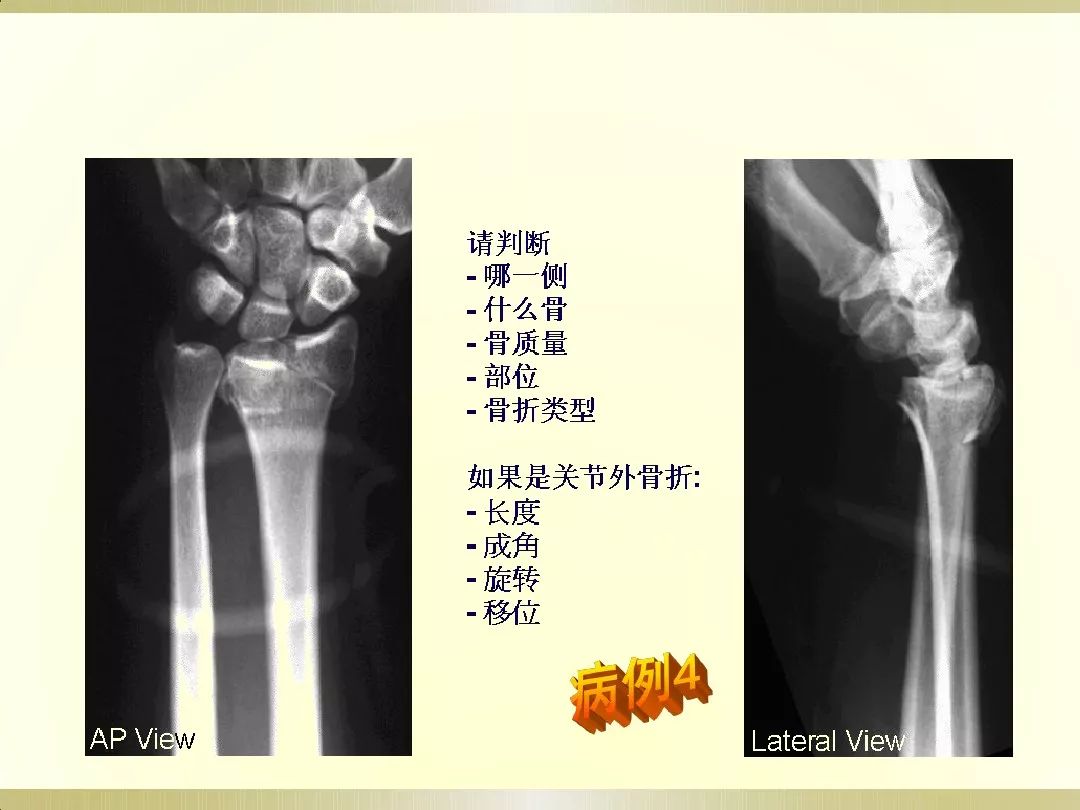 骨科x光片读片技巧,放射科骨科读片教程