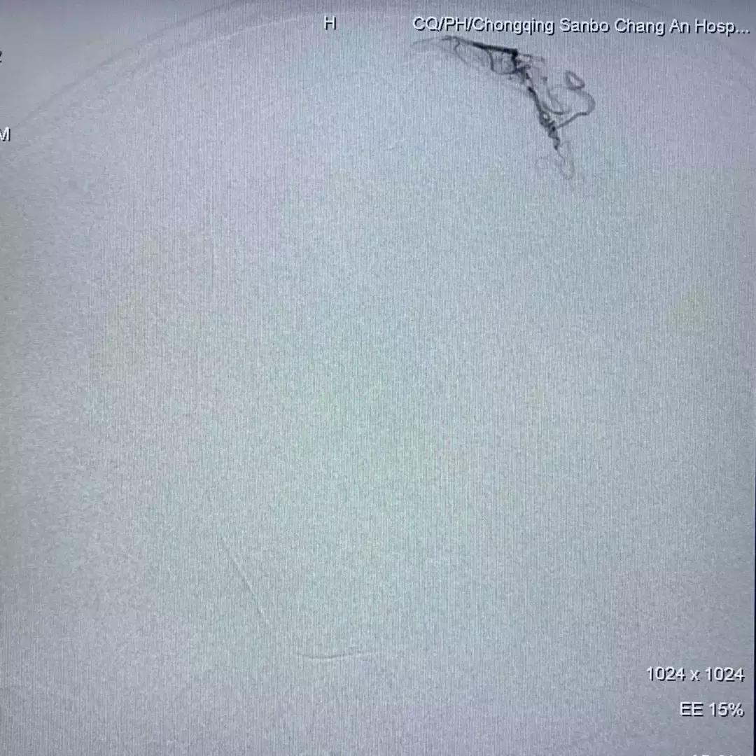 北京三博脑科医院康复治疗,北京三博脑科医院治脑血管瘤怎样