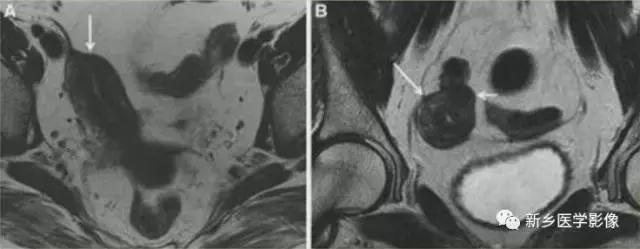 子宫发育异常，应想到的6大类常见畸形