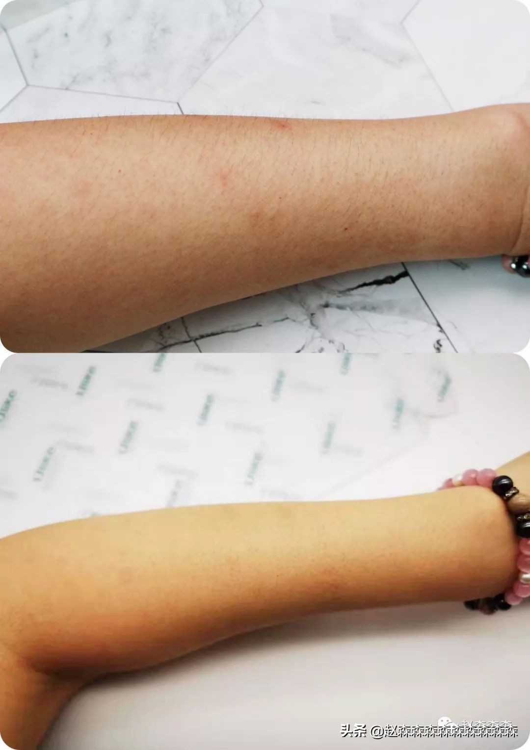 美容仪到底有没有用，拔草种草篇-强推Ulike激光脱毛仪