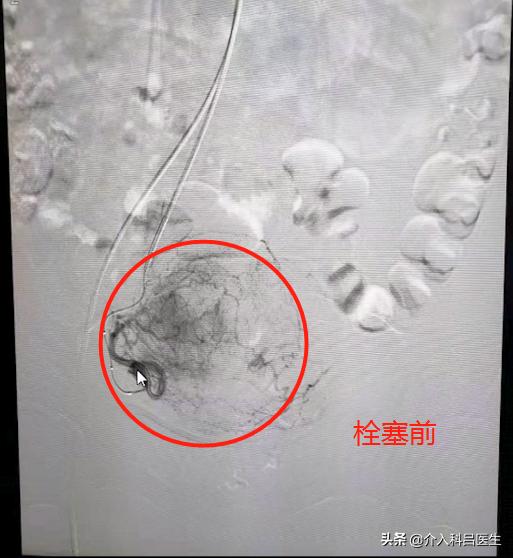 她因不堪子宫腺肌症折磨，专程从国外飞回来，接受这项微创疗法