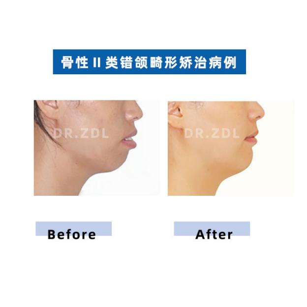 骨性龅牙和牙性龅牙的区别,牙性龅牙和骨性龅牙怎么矫正