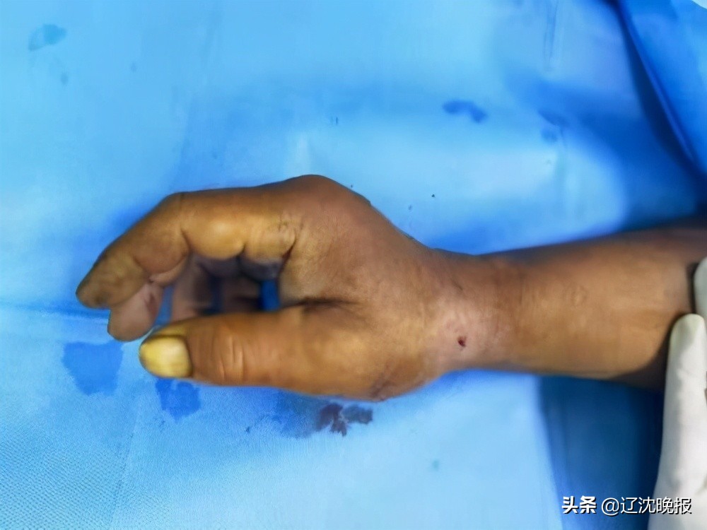 男子吃鱼被刺破大动脉,男子用鱼枪射人