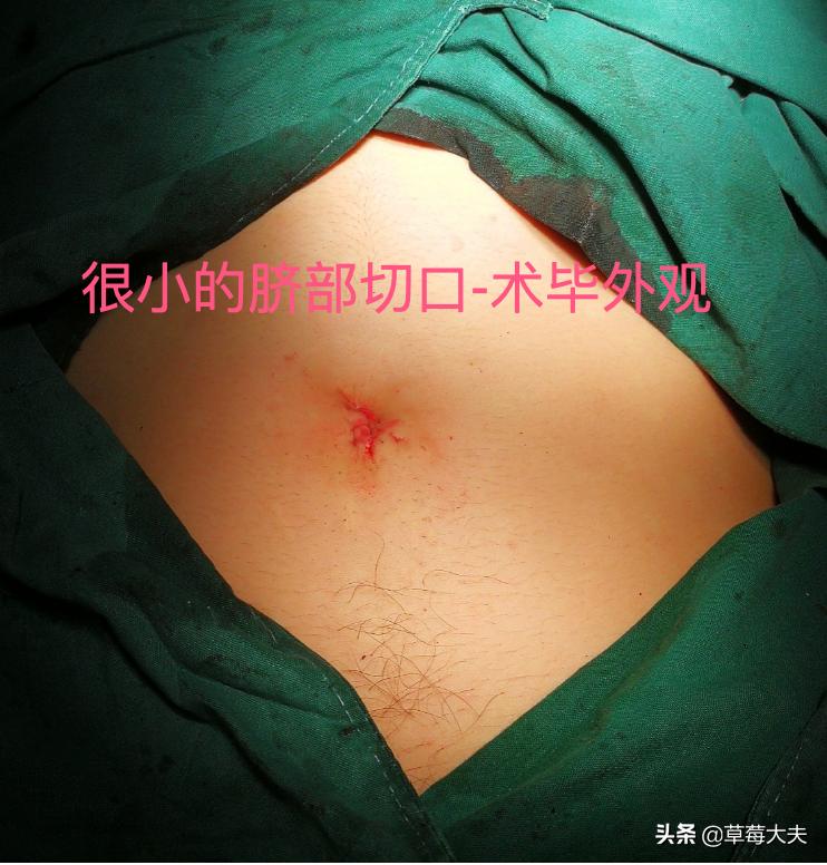 「人气案例」宫颈癌手术就得终生挂尿袋生活？草莓医院专家SayNo