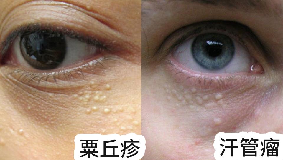 一用眼霜眼袋就严重,第一次用眼霜居然长了脂肪粒