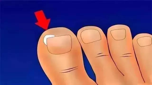 脚趾甲长进肉里剪不出来疼,彻底治愈脚趾甲往肉里长的方法