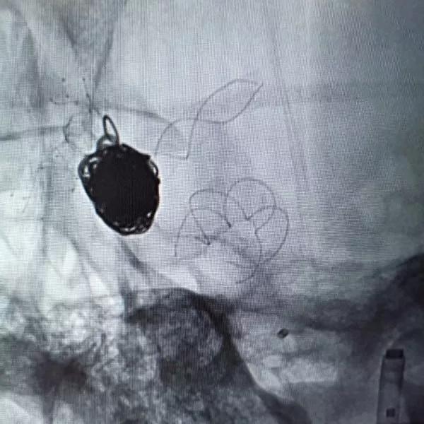 山东大学齐鲁医院王东海教授团队成功治疗多发性动脉瘤