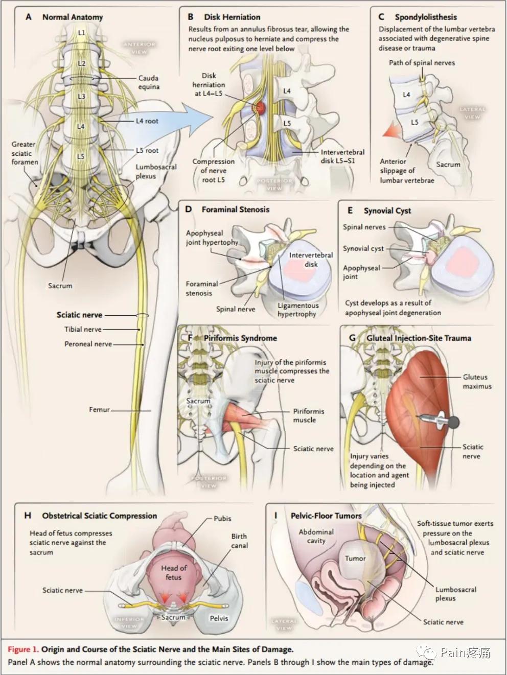 下肢疼痛是腰椎间盘突出引起的吗,下肢放射痛查不出原因