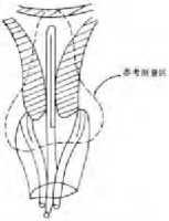 近距离放疗的副作用,近距离放疗