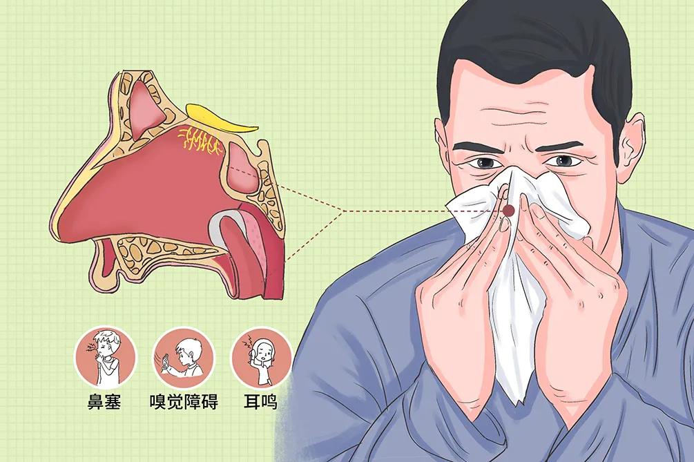 鼻息肉的症状及危害打呼噜,鼻息肉引起的鼻窦炎的症状及危害