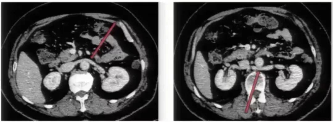 腹部ct详细讲解,腹部ct示意图及超详细教学