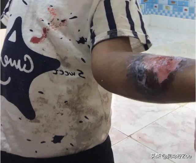 开水烫伤没有及时处理已感染,关于烫伤正确处理方法