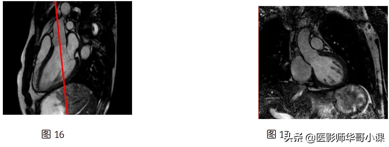 磁共振心脏扫描标准切面,心脏mri扫描定位