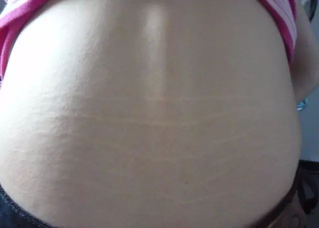 肾虚纹怎么祛除,肾虚纹你有吗