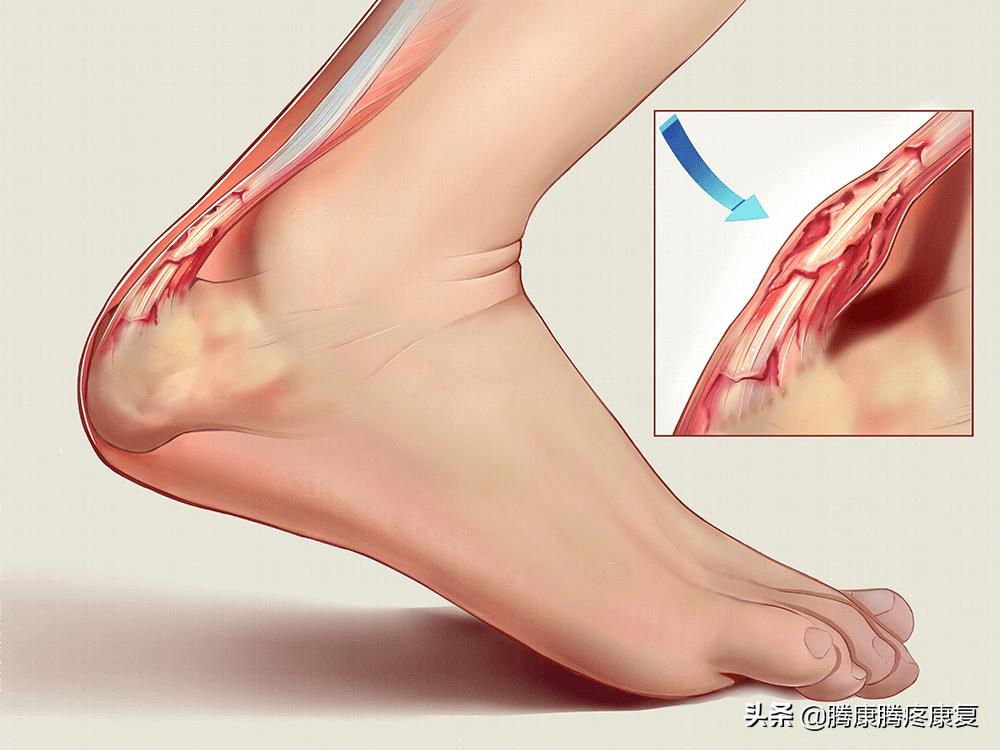 跟腱炎诊疗计划,跟腱炎四个痛点