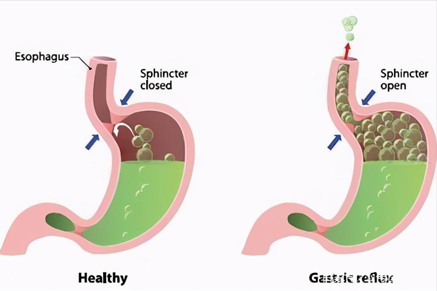 小苏打对尿酸有影响吗,小苏打对痛风有什么副作用