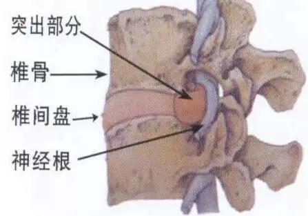 腰椎间盘突出症治愈的病例,老大爷教你治疗腰椎间盘突出