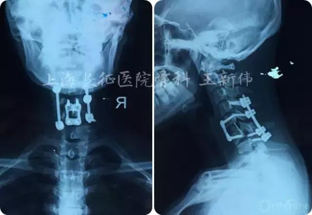 颈椎外伤受损如何治疗,颈椎损伤手术恢复怎么样