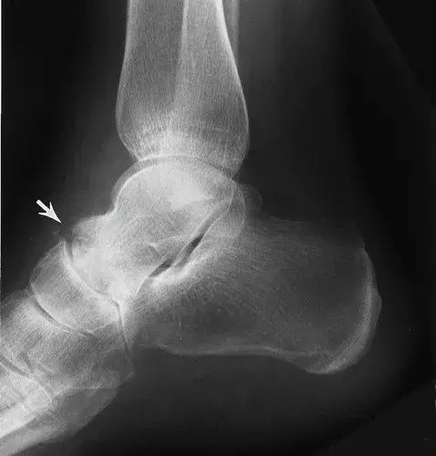 神经性骨关节病,神经性关节炎症状图片