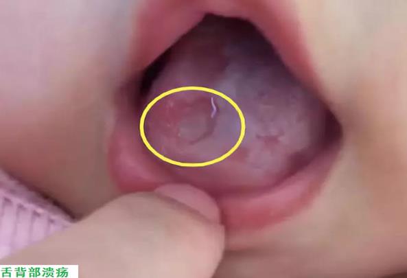 9岁孩子口腔溃疡怎么办,孩子反复口腔溃疡求良方