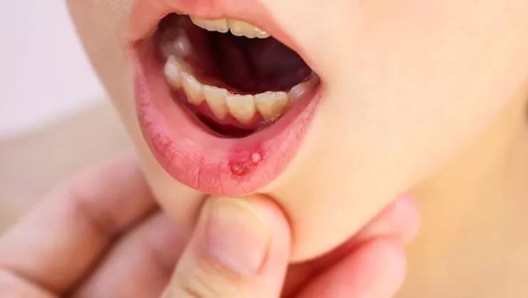 胃火心烦口腔溃疡,烦躁易怒口腔溃疡吃什么中药