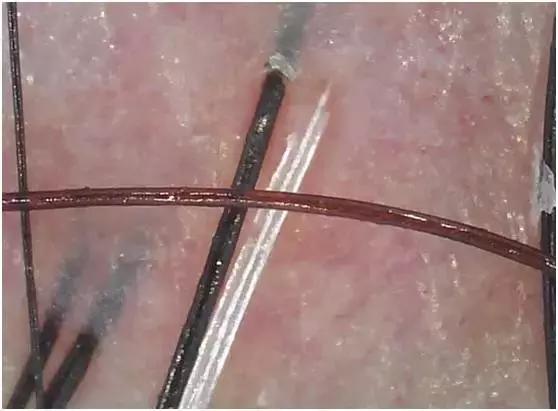 头皮清洁和头皮理疗的区别,头皮护理的意义是什么