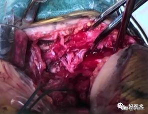 治疗肩锁关节脱位，有最好的方法吗？