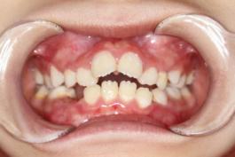 8岁的孩子能做牙齿矫正吗,7岁孩子矫正牙齿早吗