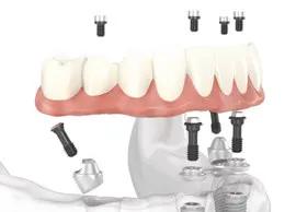 种植牙牙齿缺失的首选修复手段,牙齿缺失最佳种植方法