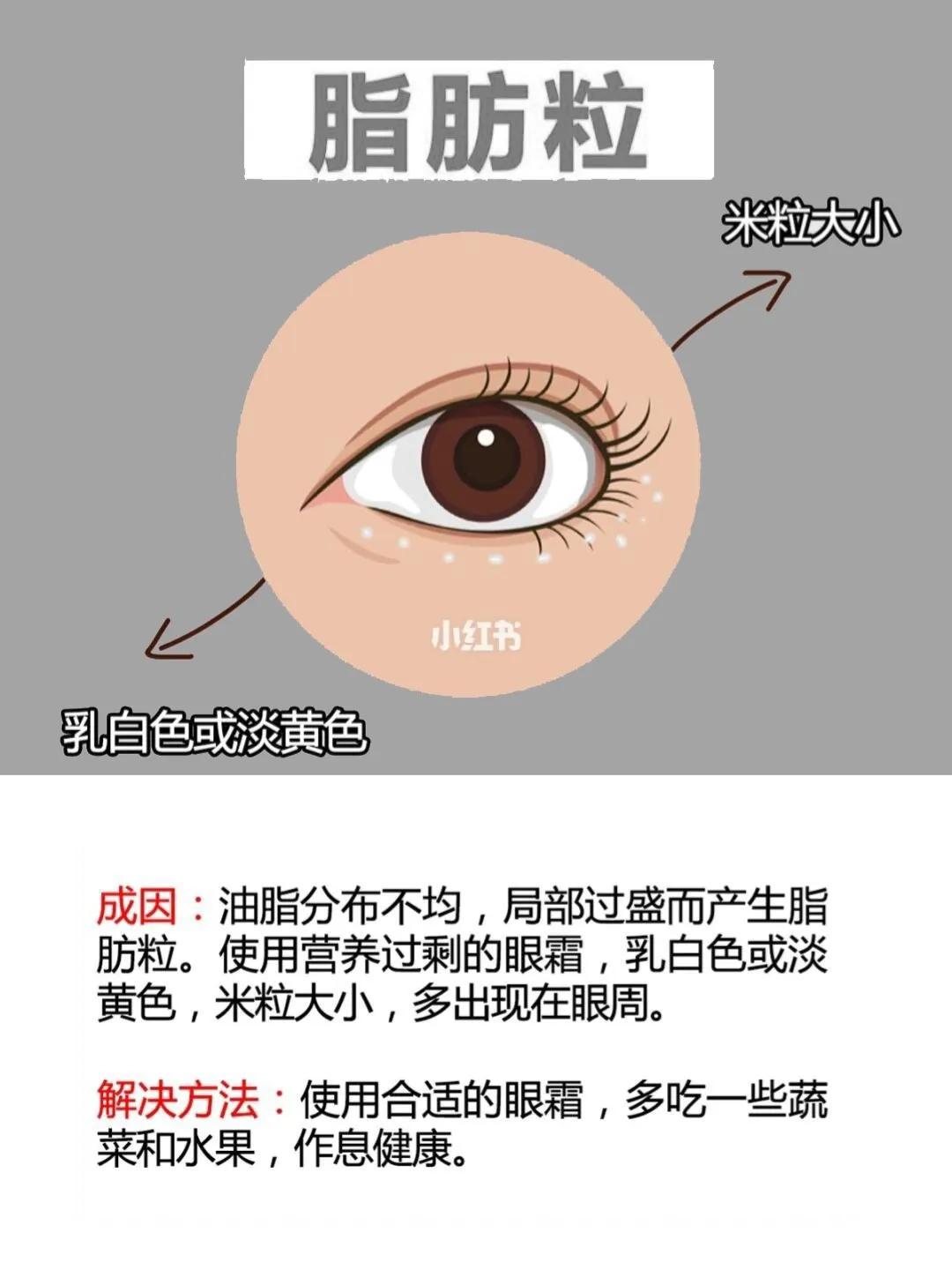 黑眼圈眼袋脂肪粒怎么去除,黑眼圈有纹有脂肪粒用什么