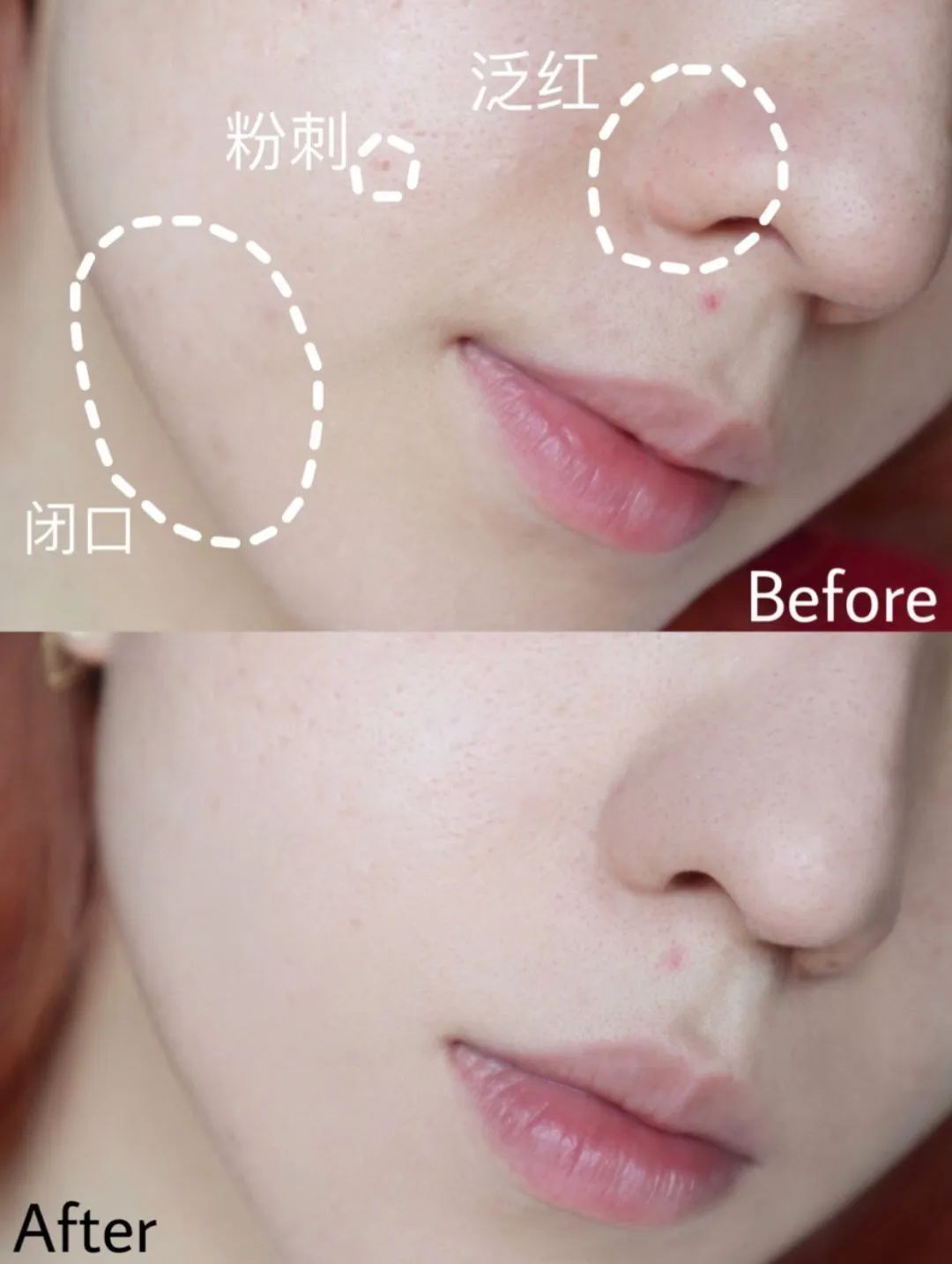 换季脸上爆痘用什么都过敏,换季过敏长痘用什么护肤品