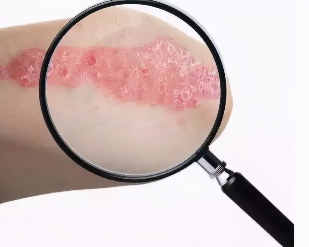 春季白癜风易复发这些因素莫忽视,得了白癜风怎么才能彻底治愈